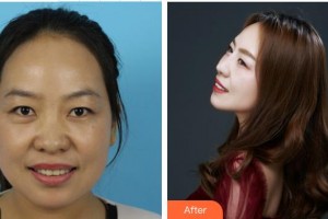 南昌普瑞眼科醫(yī)院吳慧鶯整形價格表附眼部綜合案例展示