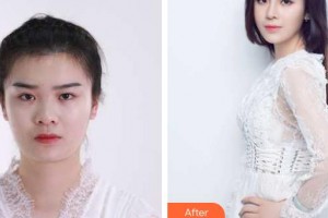 南昌愛爾眼科醫(yī)院劉學群整形價格表附切開雙眼皮案例展示