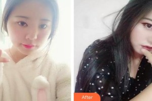 南昌大學附屬眼科醫(yī)院張超中整形價格表附定點雙眼皮案例展示