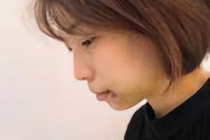 杭州時光醫(yī)療美容醫(yī)院河東鎬磨骨怎么樣?附術(shù)后果圖