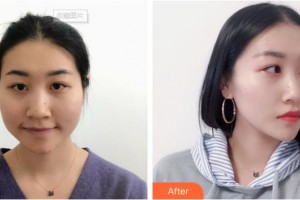 雞西市人民醫(yī)院燒傷整形科孟杰整形價格表附鼻部綜合案例展示