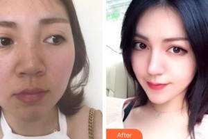 雞西王醫(yī)生整形外科門診部徐瑞宏整形價格表附硅膠隆鼻案例展示