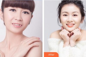 雞西王醫(yī)生整形外科門(mén)診部陳添良整形價(jià)格表附隱形托槽矯正案例展示