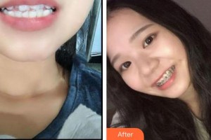 雞西王醫(yī)生整形外科門(mén)診部丁優(yōu)整形價(jià)格表附金屬托槽矯正案例展示