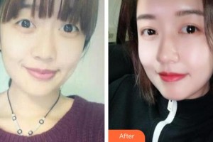 咸陽(yáng)華爾醫(yī)療美容門診部孫瑞陽(yáng)整形價(jià)格表附切開(kāi)雙眼皮案例展示