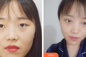 咸陽(yáng)愛(ài)爾眼科醫(yī)院劉雪芳整形價(jià)格表附切開(kāi)雙眼皮案例展示