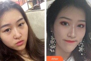 咸陽(yáng)愛(ài)爾眼科醫(yī)院陳小瑾整形價(jià)格表附切開(kāi)雙眼皮案例展示