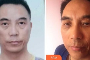 咸陽市第一人民醫(yī)院眼科醫(yī)院蒲曉莉整形價格表附激光去眼袋案例展示