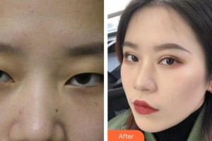 咸陽市第一人民醫(yī)院眼科醫(yī)院侯力華整形價格表附切開雙眼皮案例展示