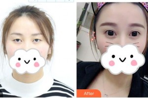 咸陽市第一人民醫(yī)院眼科醫(yī)院王芳整形價格表附眼部綜合案例展示