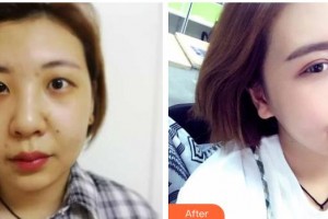 咸陽市第一人民醫(yī)院眼科醫(yī)院范強(qiáng)整形價格表附切開雙眼皮案例展示