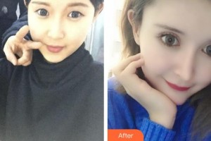 咸陽市第一人民醫(yī)院眼科醫(yī)院王娟娟整形價格表附定點雙眼皮案例展示