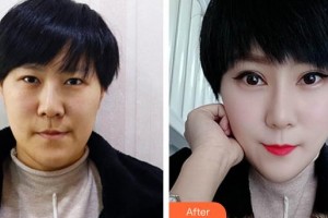 咸陽市第一人民醫(yī)院眼科醫(yī)院劉甜整形價格表附眼部修復(fù)案例展示