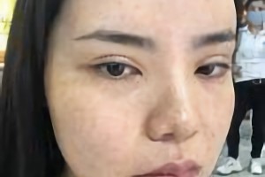 萬(wàn)家燕王珍祥做下頜角怎么樣截的多嗎？附案例分享+較新價(jià)格表