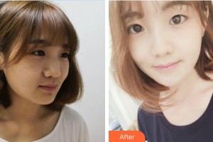 宜興品康品美醫(yī)療美容醫(yī)院丁福亮整形價(jià)格表附清潔祛痘案例展示