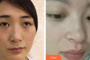 宜興市中醫(yī)院整形美容科李國(guó)春整形價(jià)格表附清潔祛痘案例展示