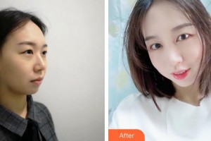 大理華山眼科醫(yī)院李敏整形價格表附切開雙眼皮案例展示