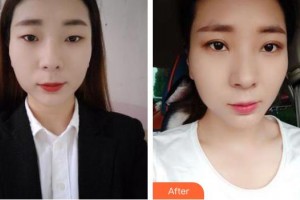 邯鄲市第七醫(yī)院整形科李九增整形價(jià)格表附激光祛斑案例展示