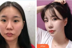 邯鄲華美醫(yī)療美容醫(yī)院王凱整形價(jià)格表附眼部綜合案例展示