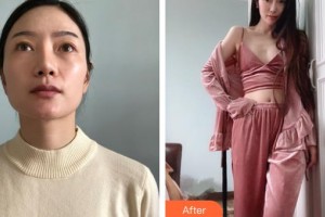 邯鄲市眼科醫(yī)院趙邯英整形價(jià)格表附外切祛眼袋案例展示