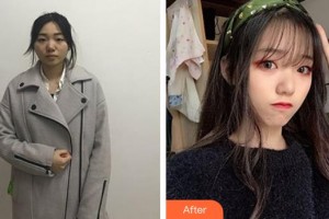 邯鄲市眼科醫(yī)院李景珂整形價(jià)格表附切開(kāi)雙眼皮案例展示