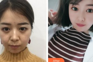 邯鄲市眼科醫(yī)院劉文茹整形價格表附眼部綜合案例展示