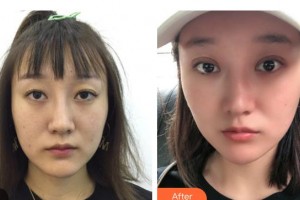 邯鄲市眼科醫(yī)院李繼英整形價(jià)格表附眼部綜合案例展示