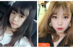 邯鄲市眼科醫(yī)院李梅霞整形價格表附切開雙眼皮案例展示