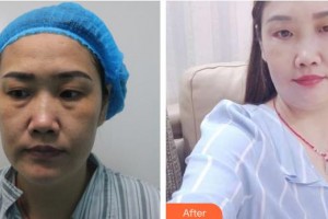 邯鄲市眼科醫(yī)院李玉剛整形價格表附切開雙眼皮案例展示