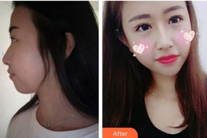 邯鄲市眼科醫(yī)院胡新宇整形價格表附定點雙眼皮案例展示