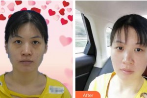 邯鄲市眼科醫(yī)院連麗英整形價格表附激光去眼袋案例展示