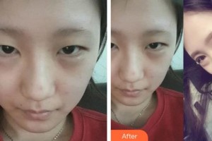 邯鄲愛眼眼科醫(yī)院郝俊華整形價格表附切開雙眼皮案例展示