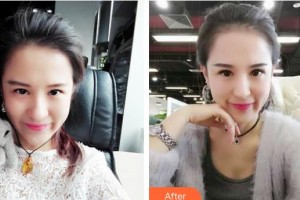 邯鄲愛爾眼科醫(yī)院王振英整形價格表附切開雙眼皮案例展示