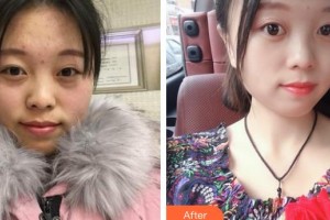 邯鄲愛爾眼科醫(yī)院呂偉整形價格表附眼部綜合案例展示