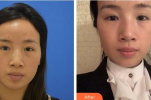 邯鄲愛爾眼科醫(yī)院申育華整形價格表附切開雙眼皮案例展示