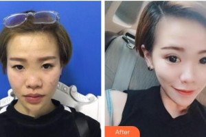 懷化市第一人民醫(yī)院黃大偉整形價格表附祛眼袋案例展示