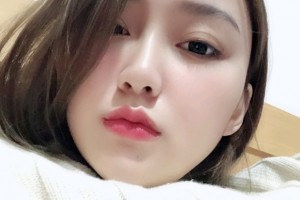 北京圣嘉新醫(yī)院下頜角手術|案例分享+名醫(yī)推薦