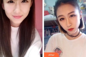 深圳德視佳眼科門診部謝繼歡整形價(jià)格表附眼部綜合案例展示