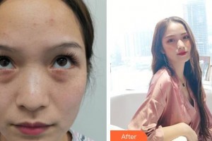 深圳德視佳眼科門診部賀純純整形價(jià)格表附激光去眼袋案例展示