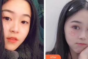 深圳市眼科醫(yī)院曾琨整形價(jià)格表附眼部綜合案例展示