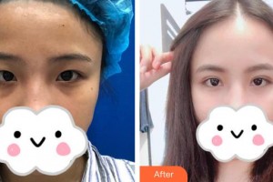 深圳華夏眼科醫(yī)院孫同整形價(jià)格表附切開(kāi)雙眼皮案例展示