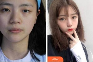 深圳市眼科醫(yī)院胡憶群整形價(jià)格表附切開(kāi)雙眼皮案例展示