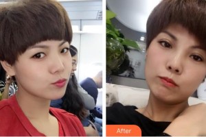 深圳市眼科醫(yī)院佘潔婷整形價(jià)格表附眼部修復(fù)案例展示