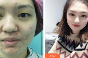 深圳?，斄猪槼毖劭漆t(yī)院林順潮整形價(jià)格表附眼部綜合案例展示