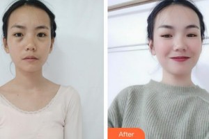 深圳市眼科醫(yī)院羅康怡整形價(jià)格表附激光去眼袋案例展示