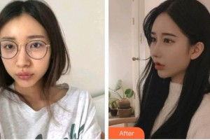 深圳愛(ài)爾眼科醫(yī)院夏娟整形價(jià)格表附內(nèi)切祛眼袋案例展示