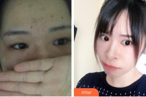 深圳愛(ài)爾眼科醫(yī)院鄧宏偉整形價(jià)格表附定點(diǎn)雙眼皮案例展示