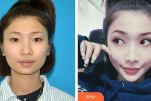 深圳愛爾眼科醫(yī)院鐘華紅整形價格表附內(nèi)切祛眼袋案例展示