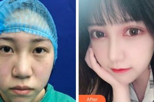 深圳愛爾眼科醫(yī)院馬慧明整形價格表附切開雙眼皮案例展示