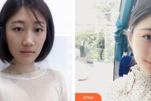 深圳愛爾眼科醫(yī)院林偉璇整形價格表附眼部綜合案例展示